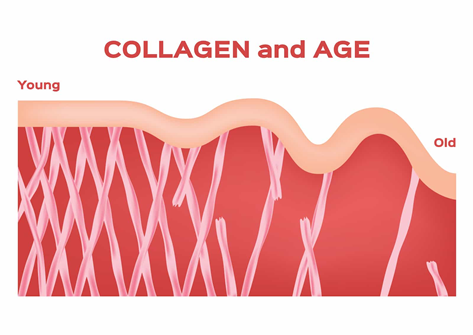 Collagen decrease and the formation of wrinkles